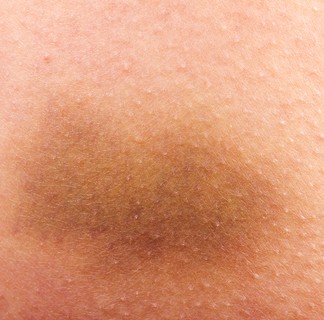 bruise easily while dieting